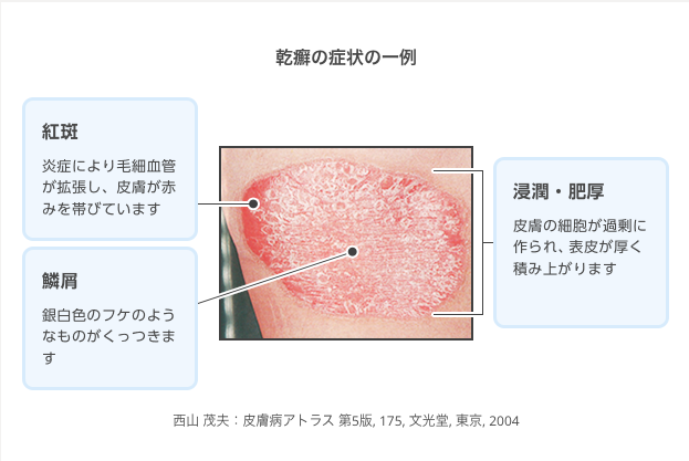 ぷろたん乾癬